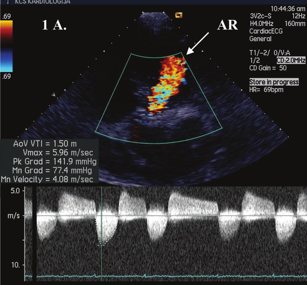 Veličina aortnog anulusa i izgled aortne valvule na MSCT-u sne srčane šupljine su bile normalnih dimenzija.
